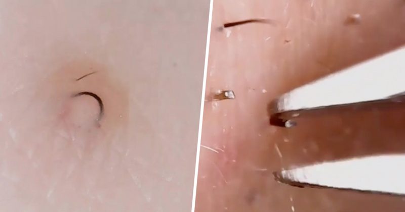 These Extreme Close Ups Of Ingrown Hair Removal Are The Most